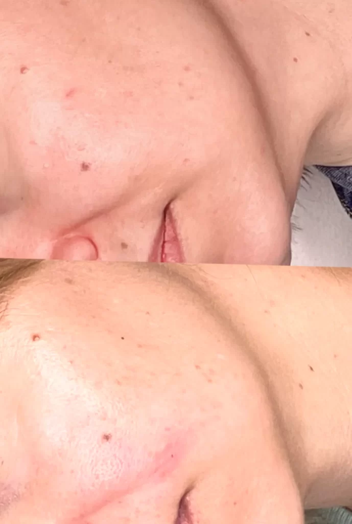 acne treatment results timeline