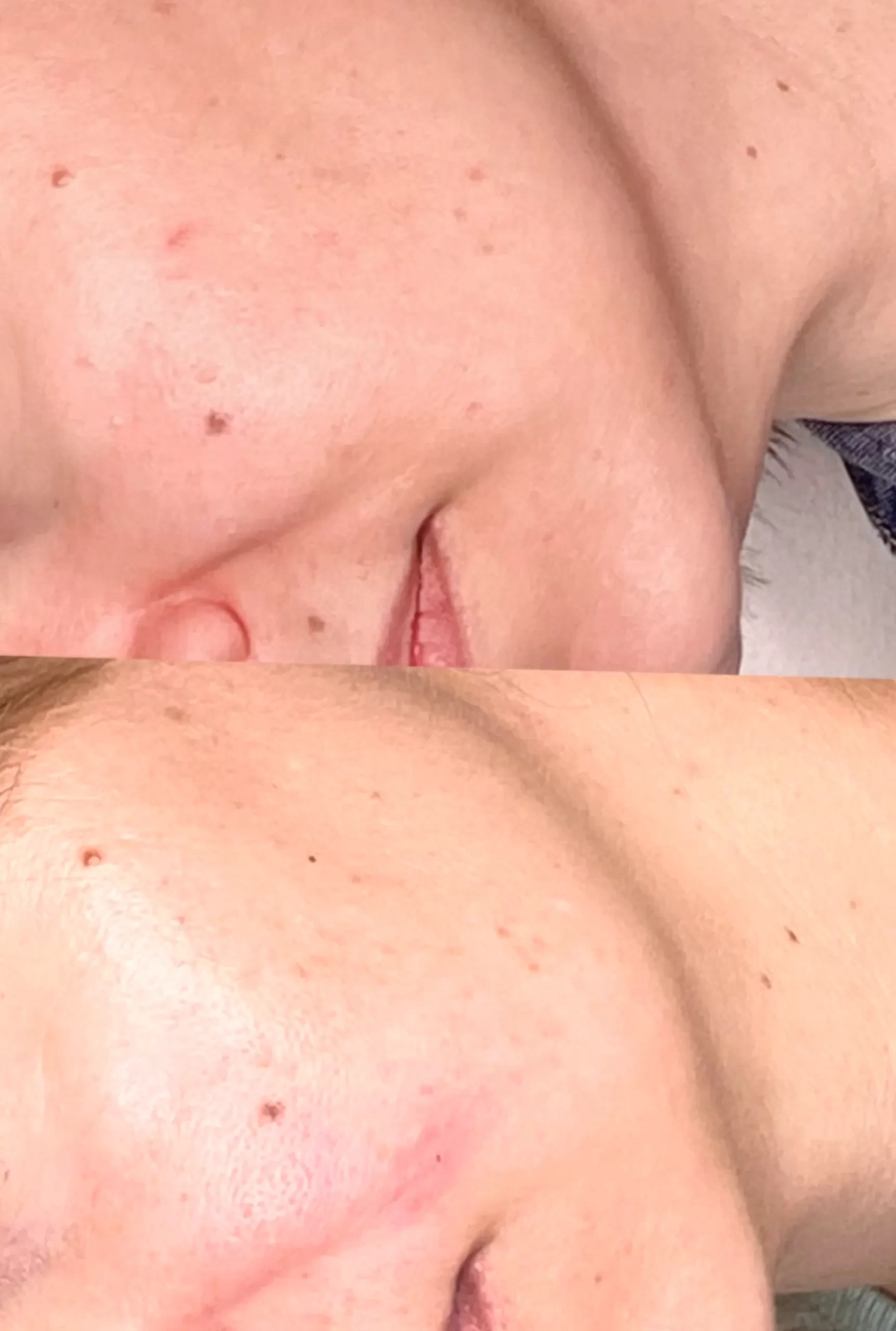 acne treatment results timeline