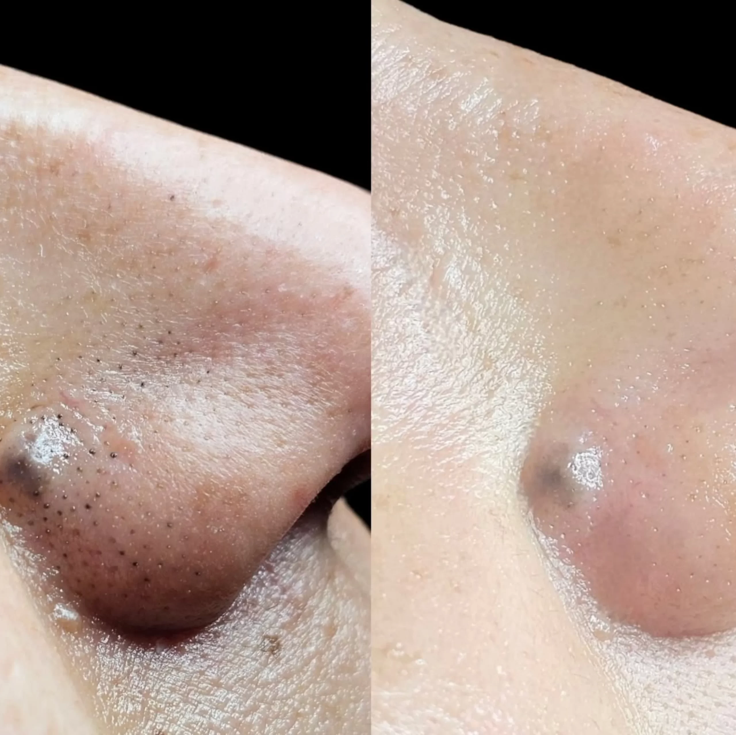 collagen stimulation results time
