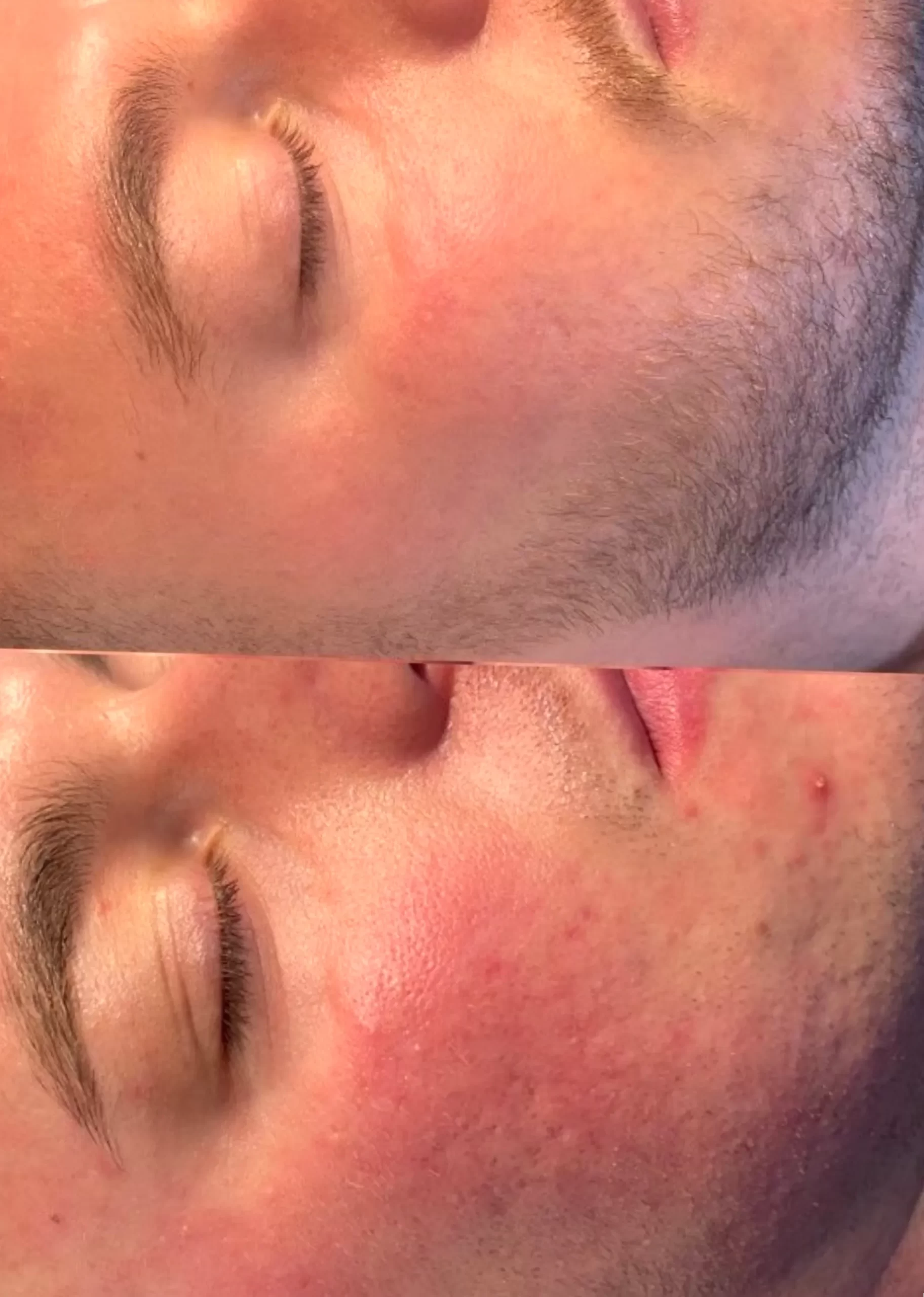 pigmentation fading timeline