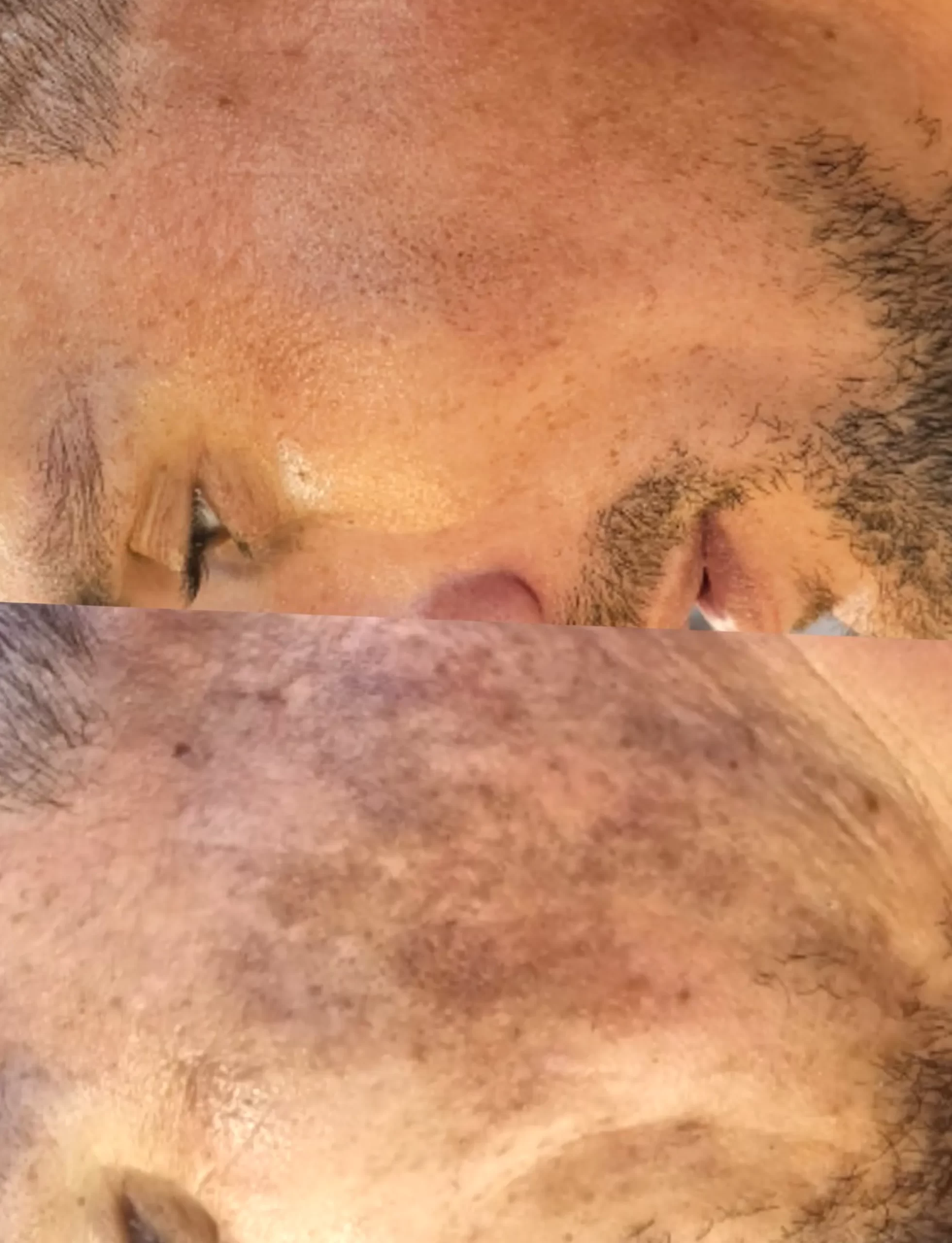 skin improvement timeline