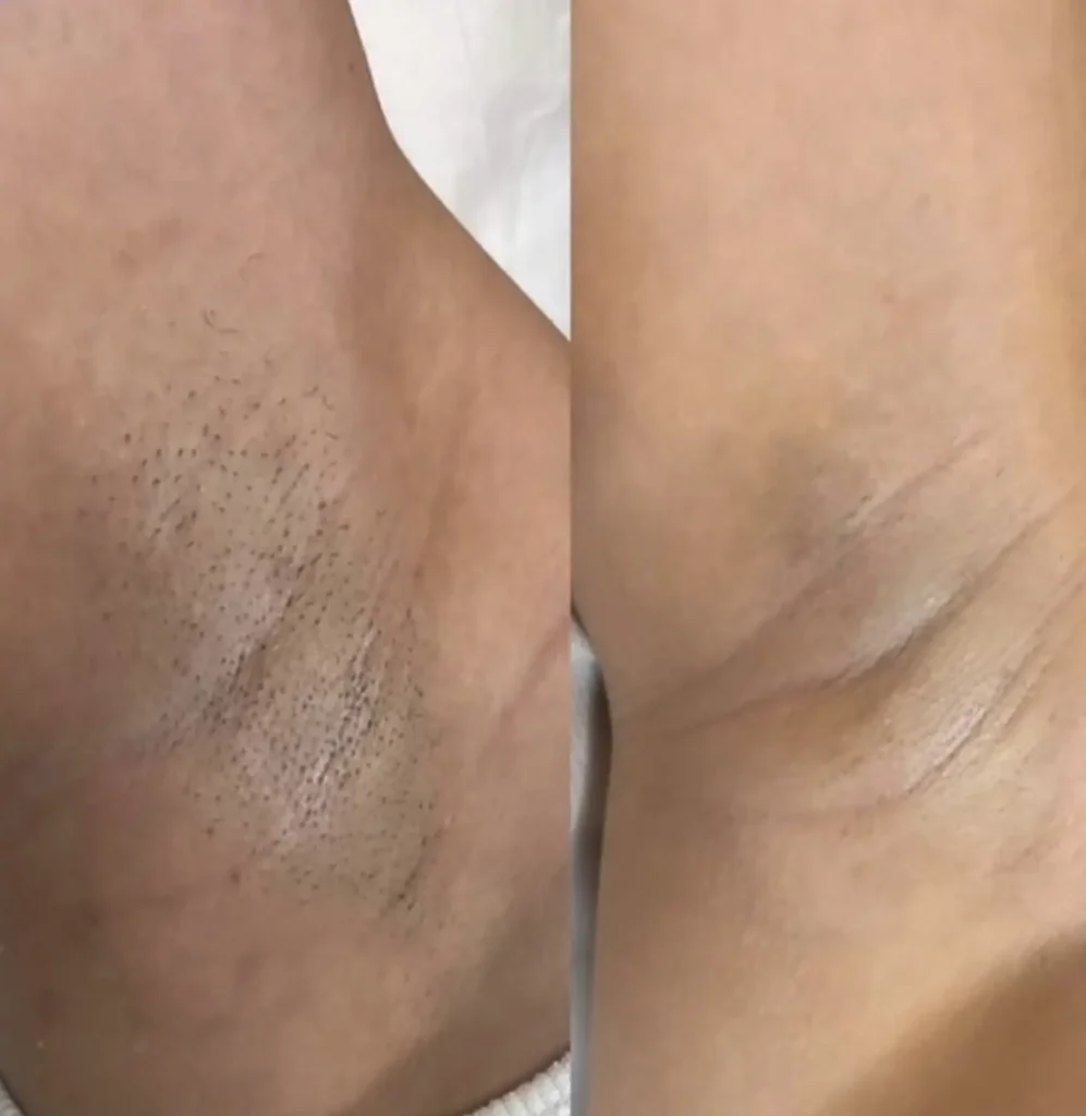 Which Courses Include Training On “Triple-Wavelength” (Alex/Diode/YAG) Combined Handpieces?